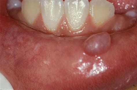 mucocele oral - candidiasis oral tratamiento